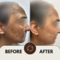 Cosmelan Treatment Results 85x85