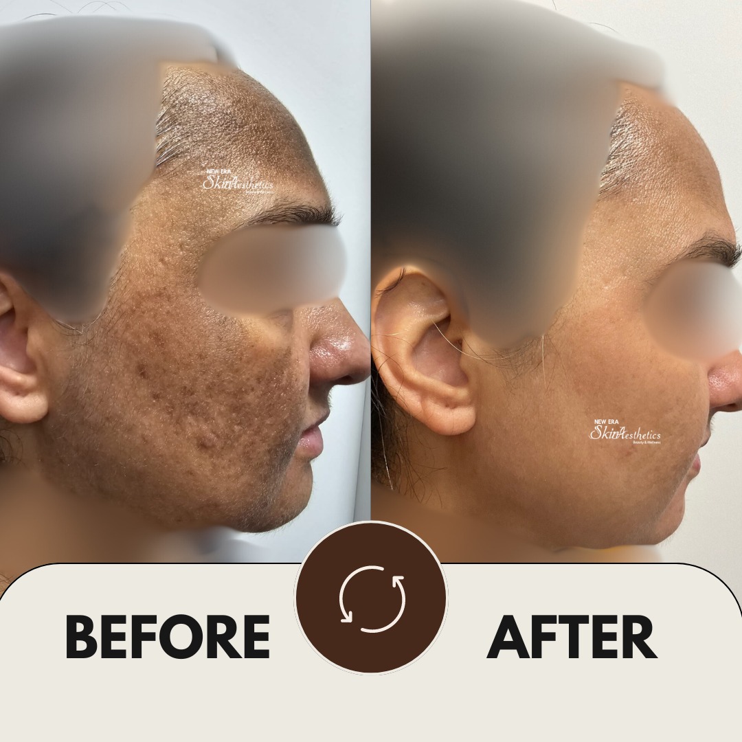 Cosmelan Treatment